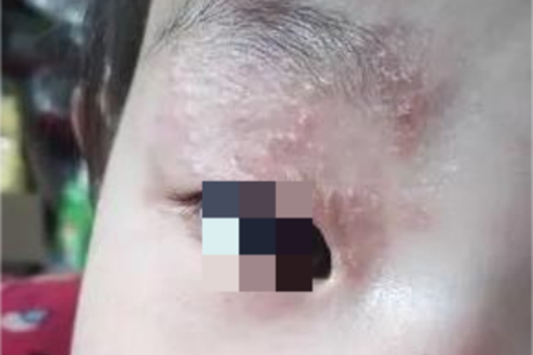 汗腺瘤眼周丘疹图