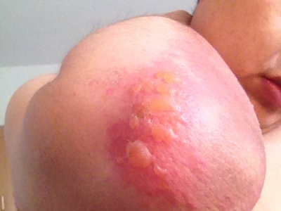 蜈蚣蜇伤的症状和图片 - 有来医生