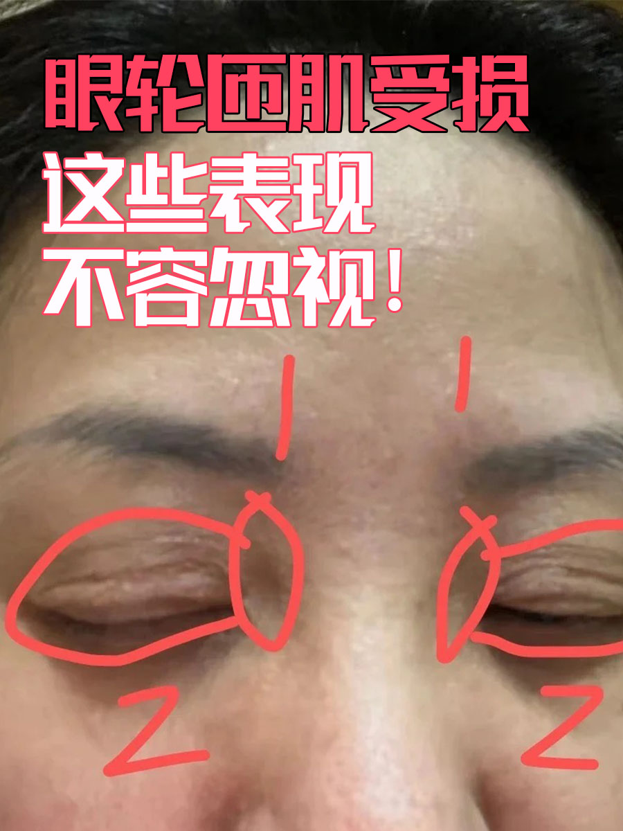 眼轮匝肌受损,这表现不容忽视!