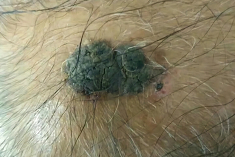 疣状脂溢性角化症头皮症状图 疣状脂溢性角化症头皮症状图