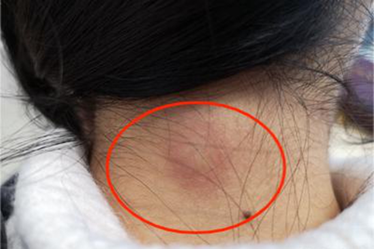 皮样囊肿后颈肿块图 皮样囊肿后颈肿块图