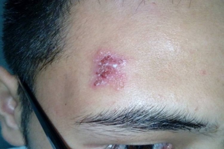 单纯疱疹面部长水疱还结痂图 单纯疱疹面部长水疱还结痂图