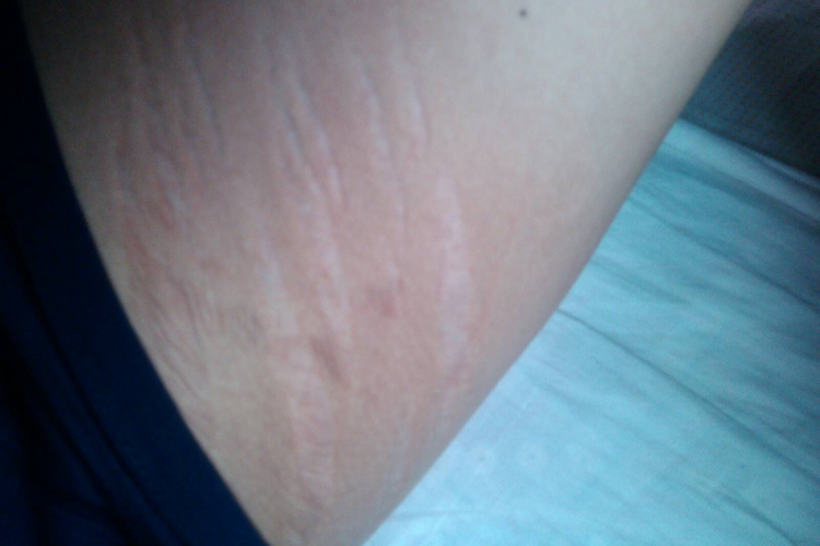 大腿内侧皮肤褶皱图