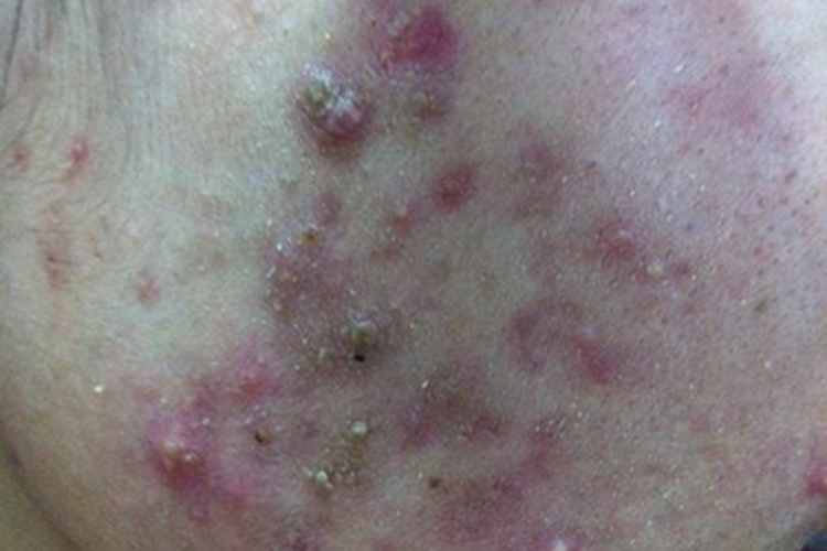 聚合性痤疮面颊有脓包图