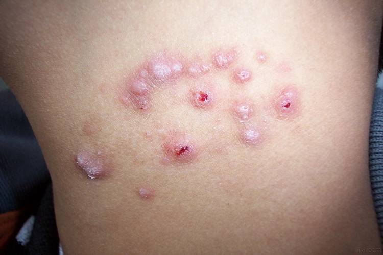 肉芽肿图 肉芽肿图