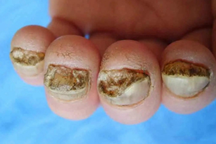 后天性厚甲症手指甲症状图