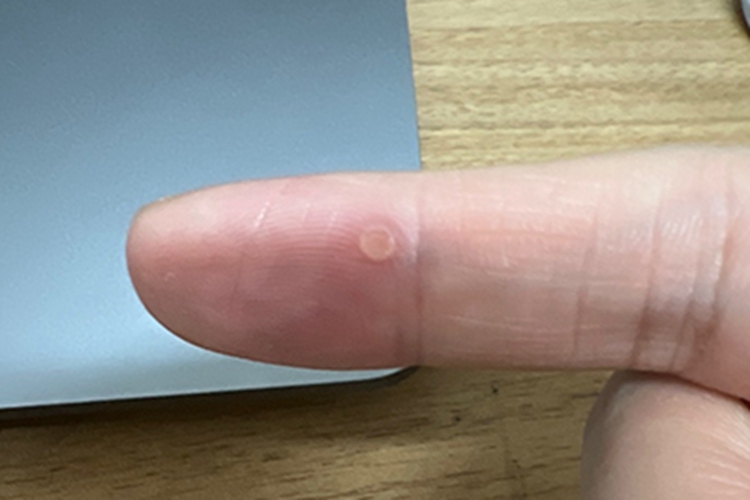 寻常疣食指长扁平小疙瘩图