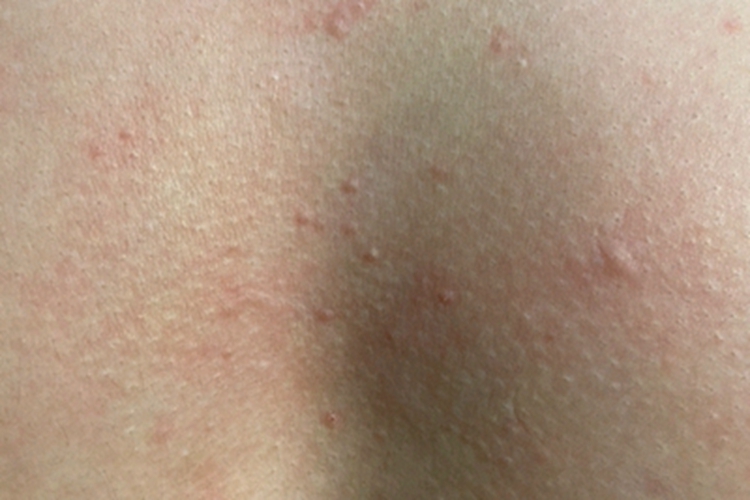 毛囊炎胸部小红丘疹图