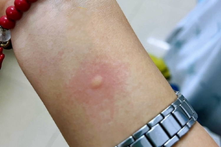 蚁蜇伤包块图 蚁蜇伤包块图