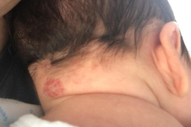 新生儿脖子后面血管瘤图 新生儿脖子后面血管瘤图