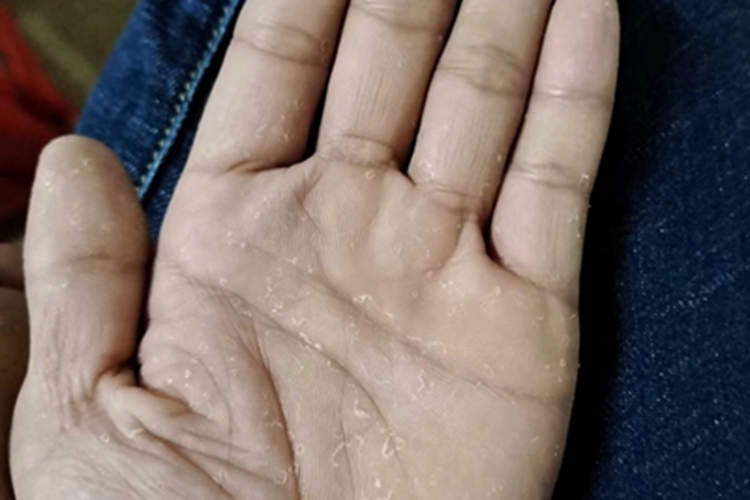 汗疱疹脱屑图 汗疱疹脱屑图