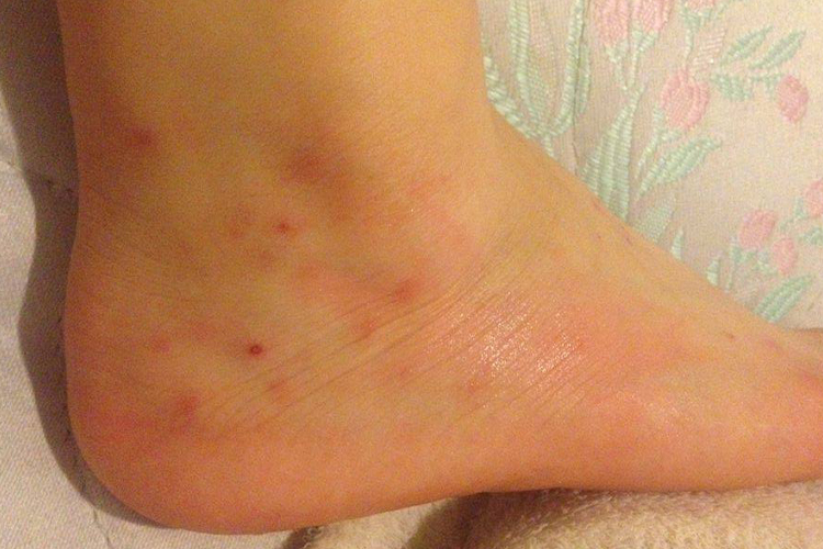 艾滋病初期脚踝小红点图