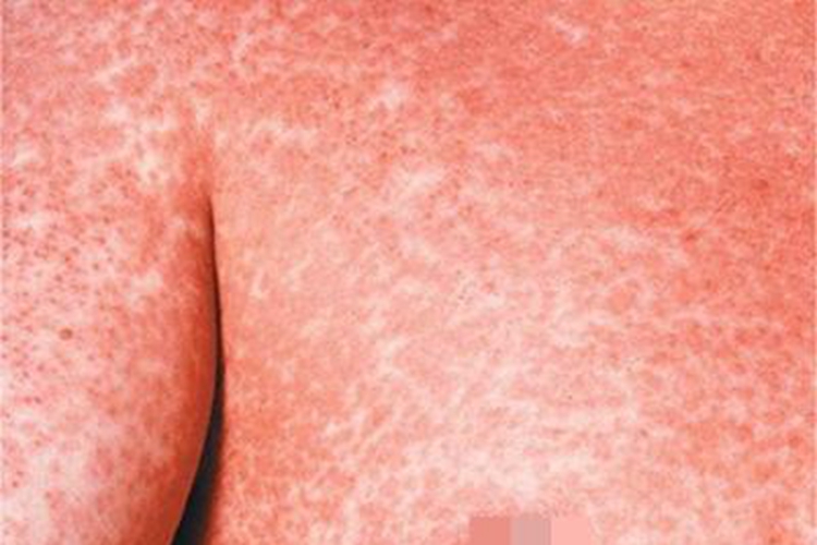 湿疹样紫癜胸部症状图 湿疹样紫癜胸部症状图