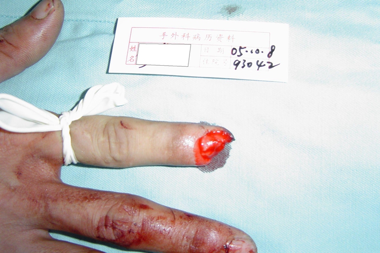 右手食指缺损图 右手食指缺损图