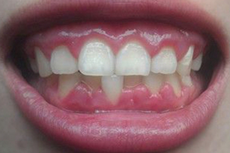 牙龈瘤牙龈包块图 牙龈瘤牙龈包块图