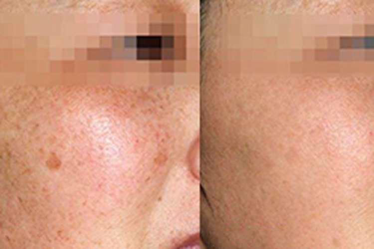 点阵激光祛色素沉着对比图
