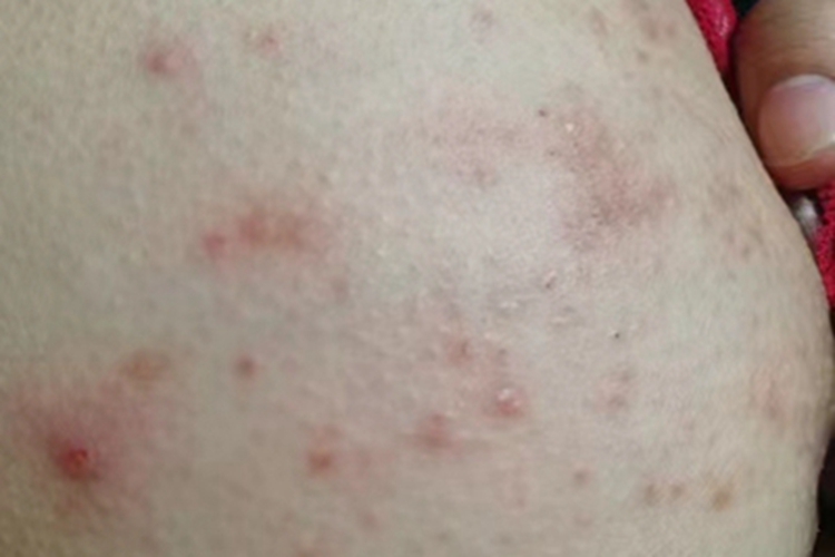 亚急性湿疹膝盖症状图