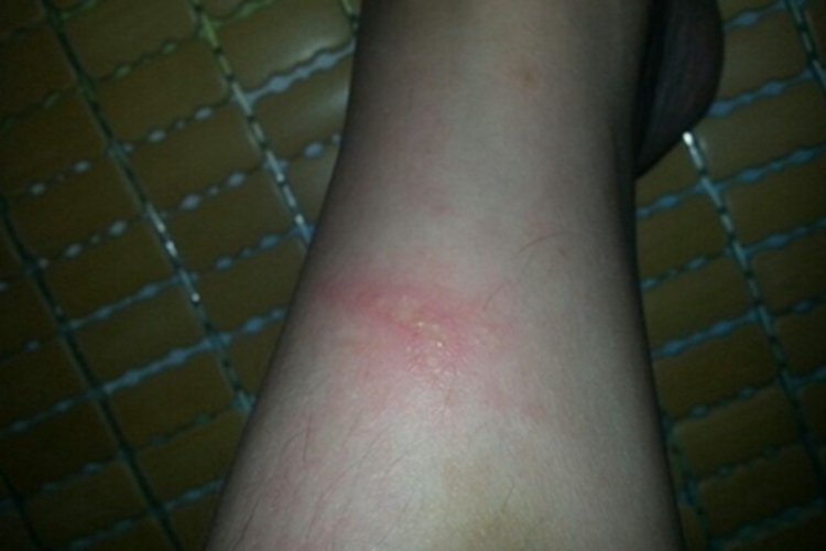 急性接触性皮炎小腿红斑水疱图
