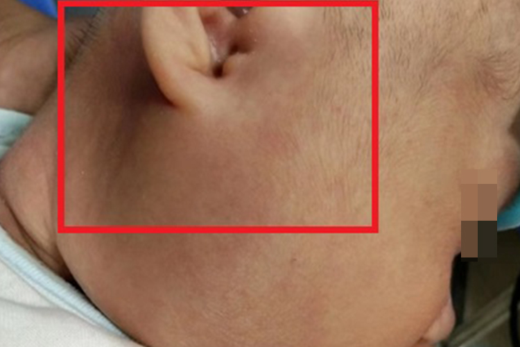 儿童复发性腮腺炎耳前水肿图