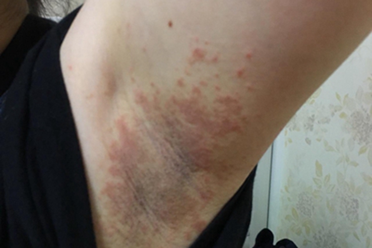 间擦疹腋窝症状图 间擦疹腋窝症状图