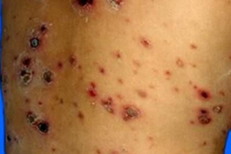 痘疮样型副银屑病症状图 痘疮样型副银屑病症状图