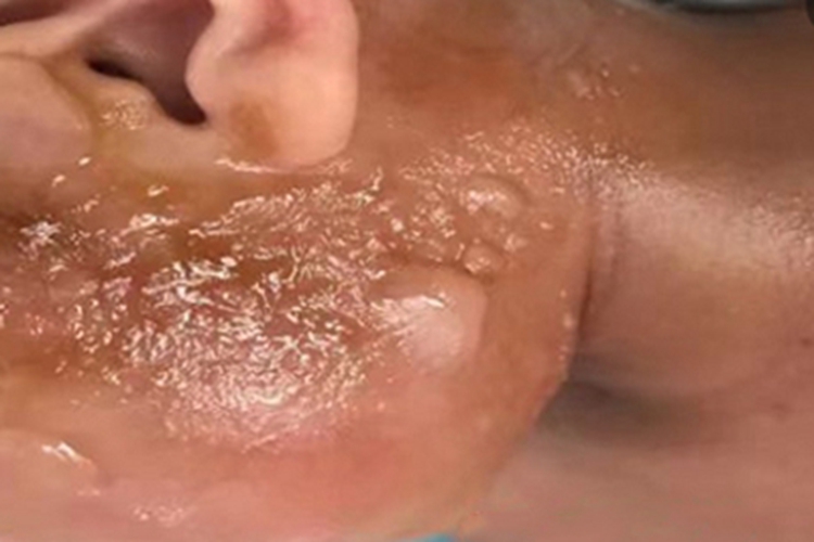 脓疱疮面部水疱图