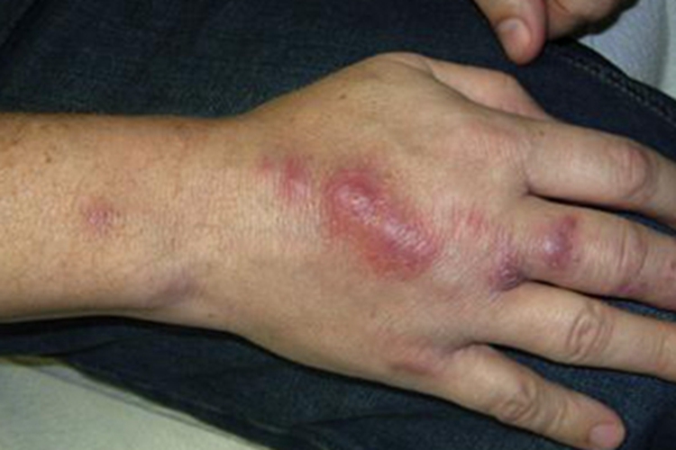 皮肤非典型分枝杆菌病大红疙瘩图 皮肤非典型分枝杆菌病大红疙瘩图