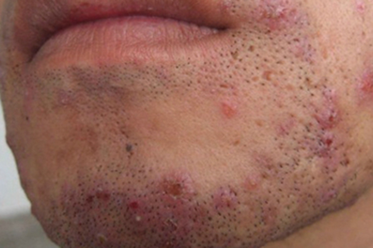 须疮下巴症状图