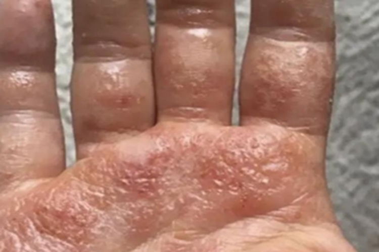 手部湿疹手指长一片水疱图 手部湿疹手指长一片水疱图