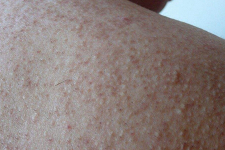 毛发角化病背部丘疹图