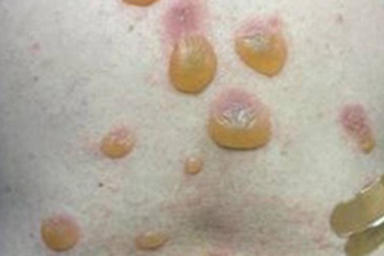 红斑型天疱疮胸部水疱图 红斑型天疱疮胸部水疱图