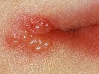 复发性口腔单纯性疱疹嘴角起一簇水疱图.jpg