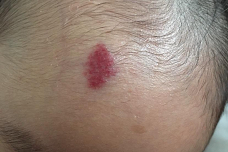 浅表型婴儿血管瘤红斑图