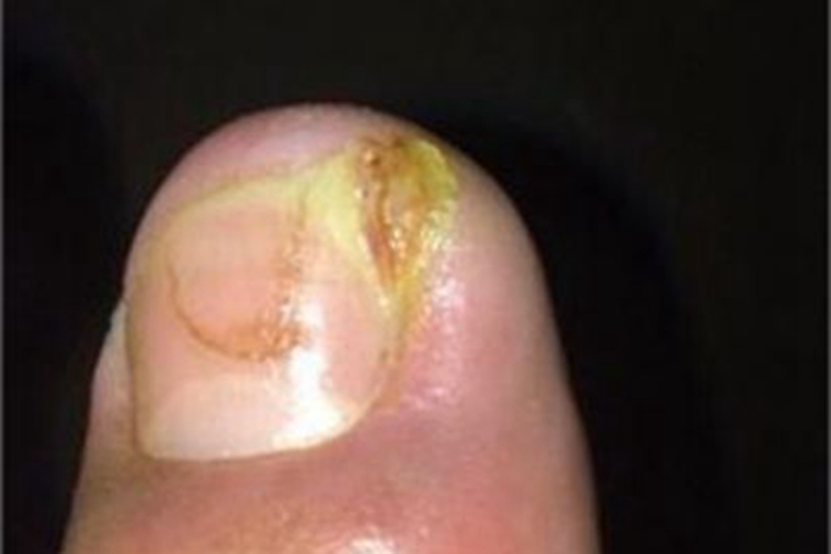 化脓性甲沟炎黄痂图