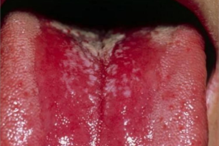 口腔毛状黏膜白斑舌头白斑图