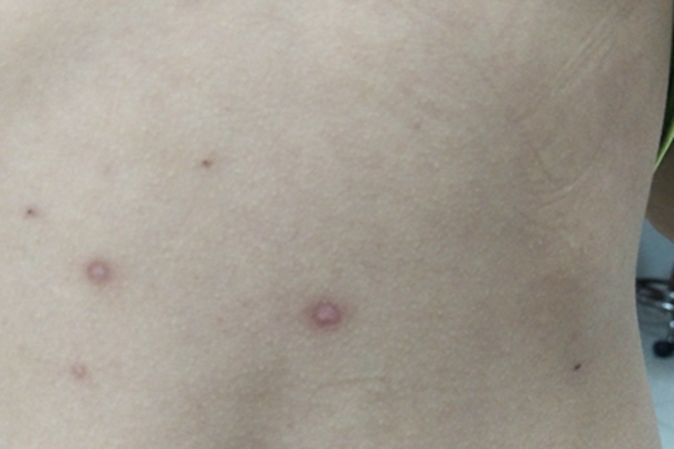 水痘肚子上有瘢痕图