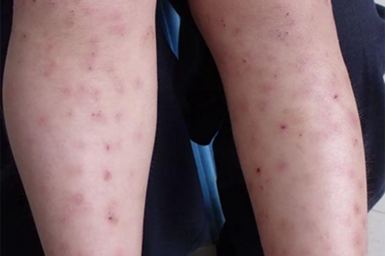 结痂性疥疮小腿小疙瘩图