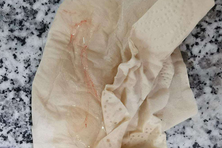 小便后擦拭白带有血丝图 小便后擦拭白带有血丝图