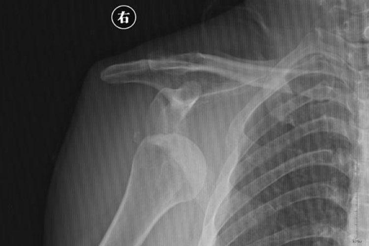 肩关节前脱位X线图 肩关节前脱位X线图