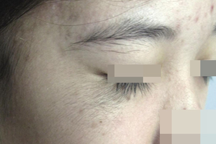 多毛症眼周毛发过长图