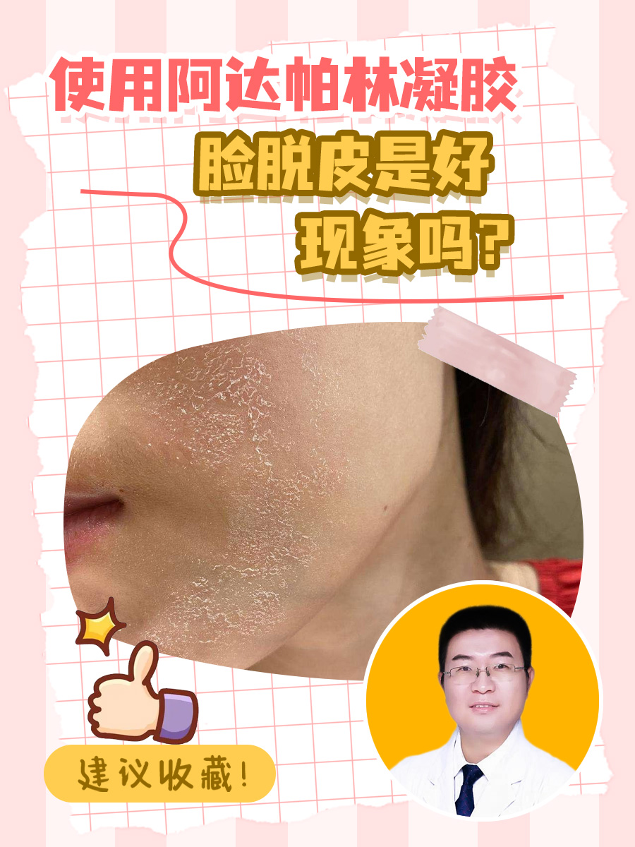 使用阿达帕林凝胶，脸脱皮是好现象吗？