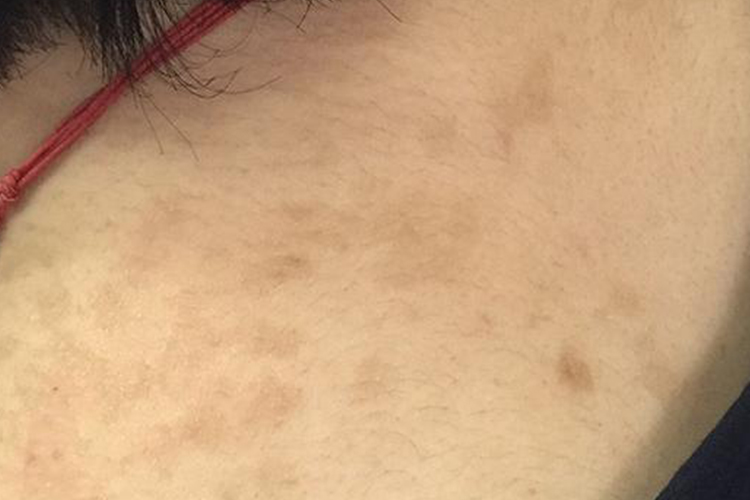 凡士林过敏后遗留的色素沉着图