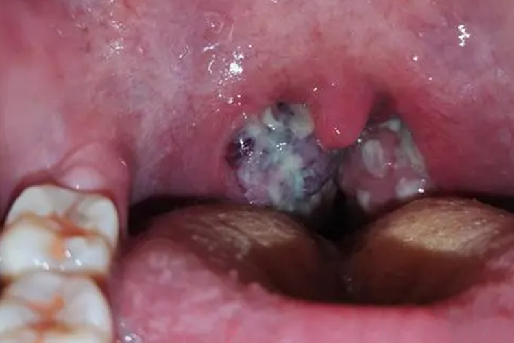 扁桃体黑色素瘤图