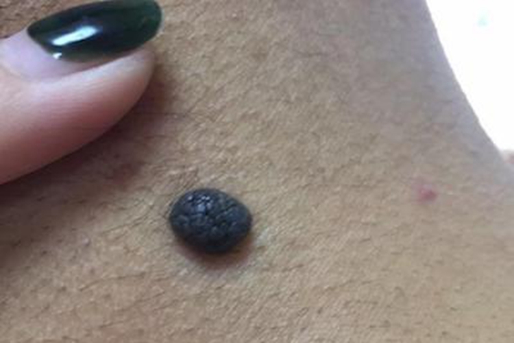 结节型黑色素瘤后脖子上长结节图