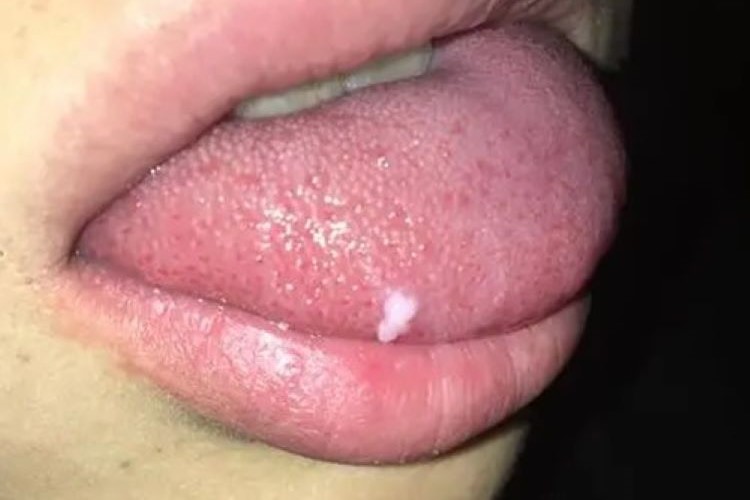 尖锐湿疣舌头白色肉芽图