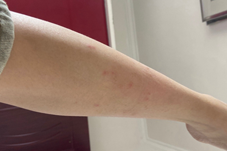 虫咬皮炎小腿红点图 虫咬皮炎小腿红点图