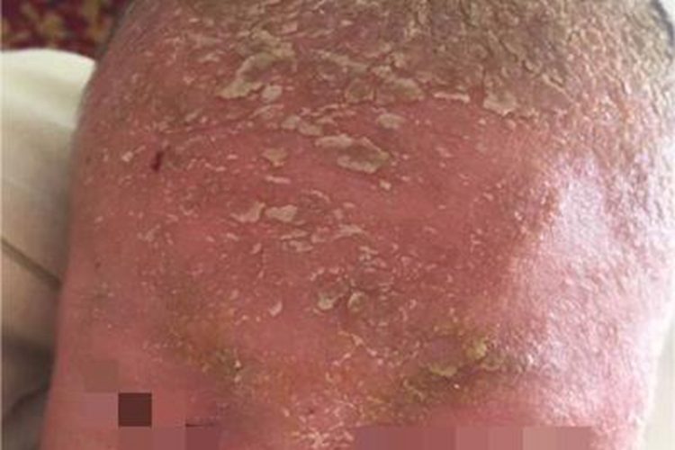 奶癣头部红斑图 奶癣头部红斑图