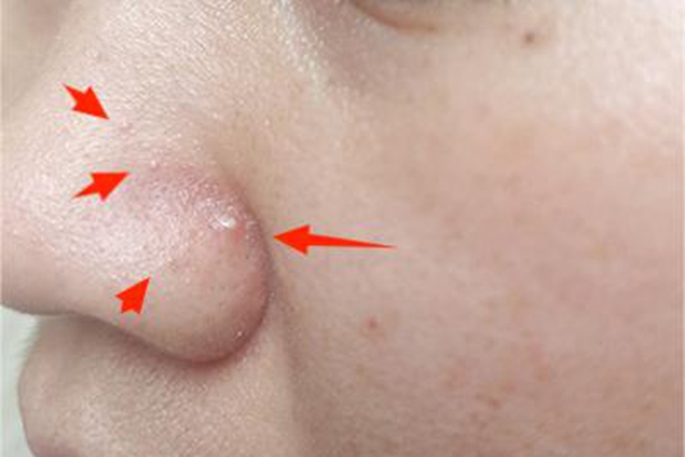 毛囊炎鼻翼部有几个疙瘩图