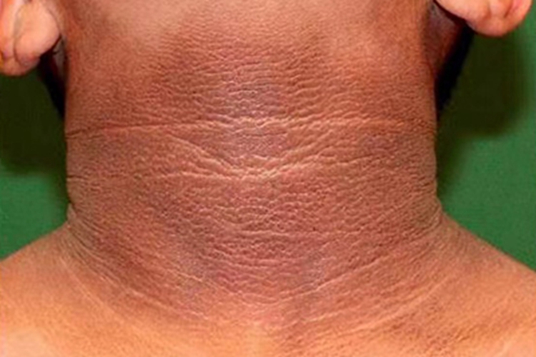 皮肤垢着病颈部黑斑图 皮肤垢着病颈部黑斑图