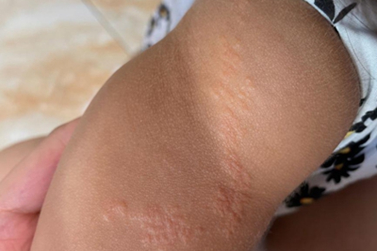 线状苔藓胳膊上长串联的丘疹图